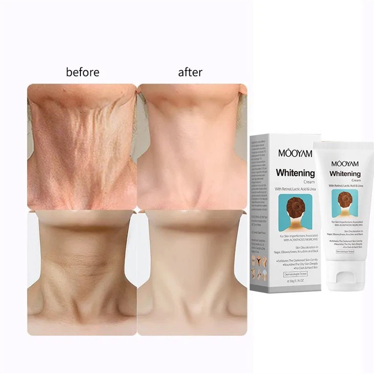 Acanthosis Nigricans Therapy Cream